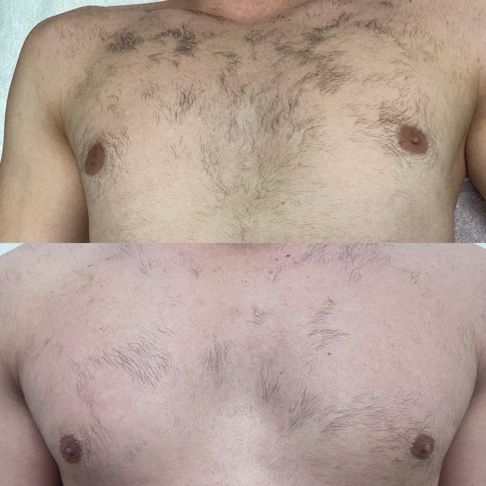 prima e dopo laser centro estetico catanzaro (10)