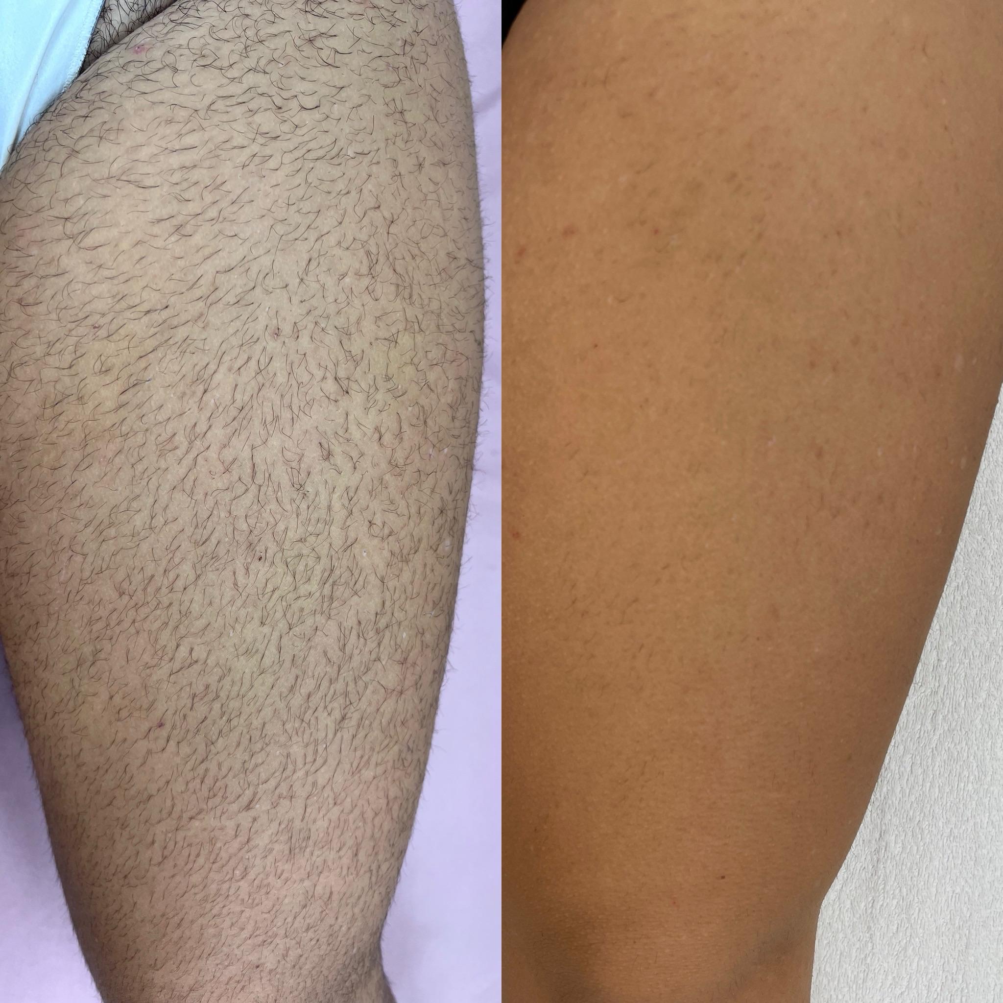 prima e dopo laser centro estetico catanzaro (11)