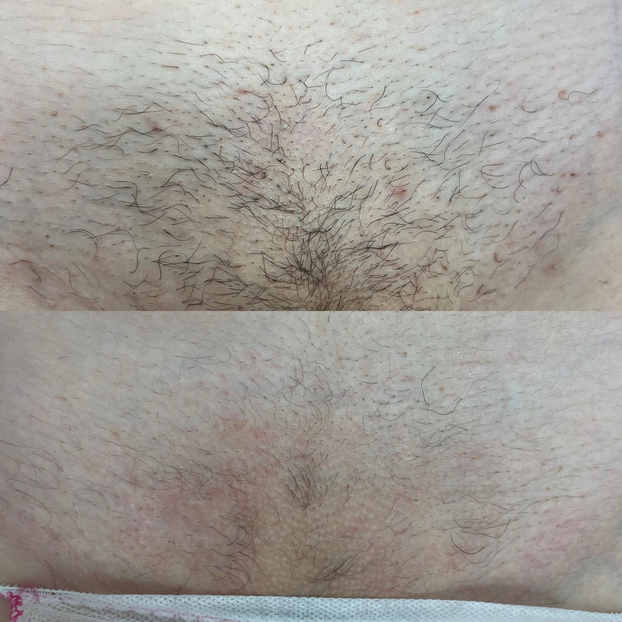 prima e dopo laser centro estetico catanzaro (4)