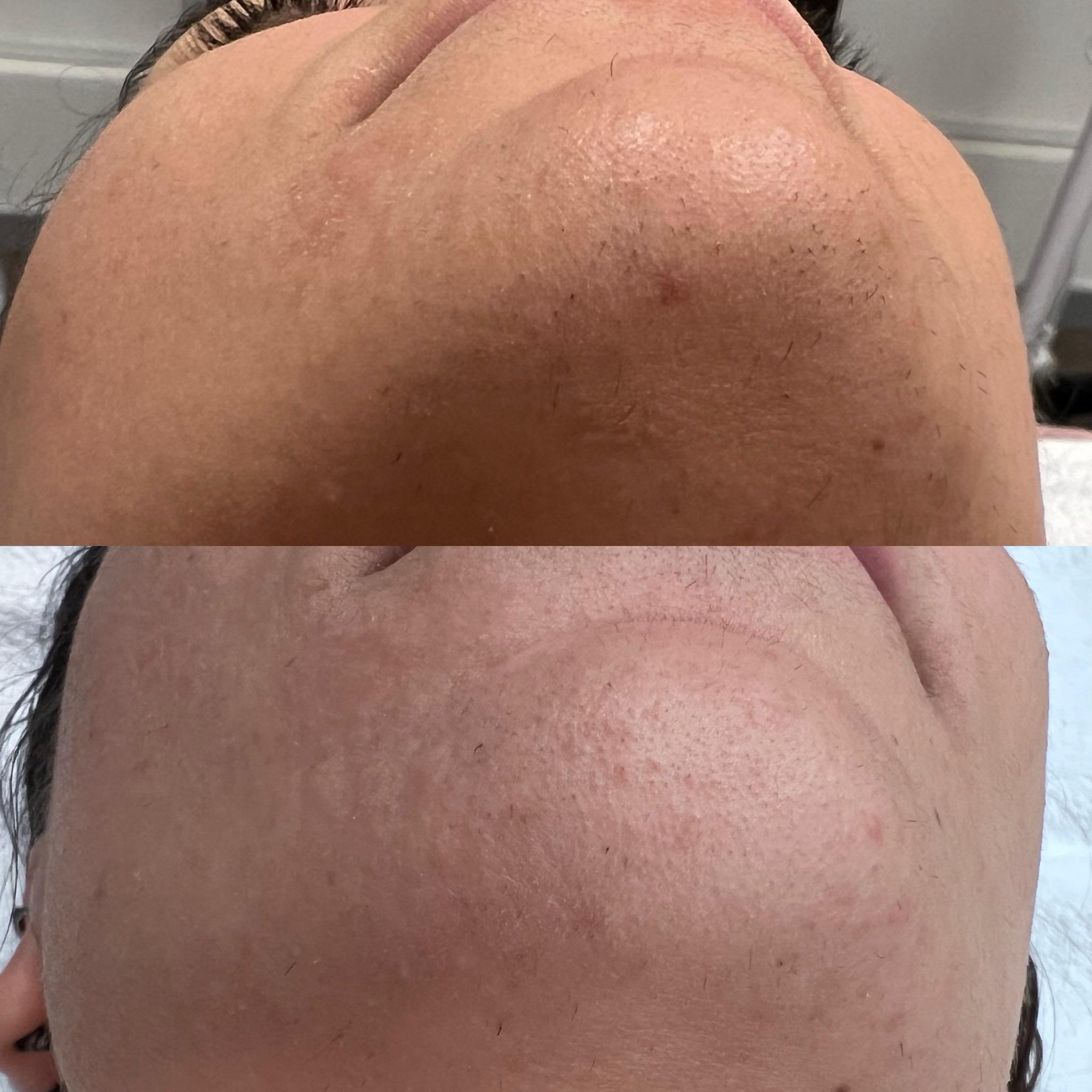 prima e dopo laser centro estetico catanzaro (6)