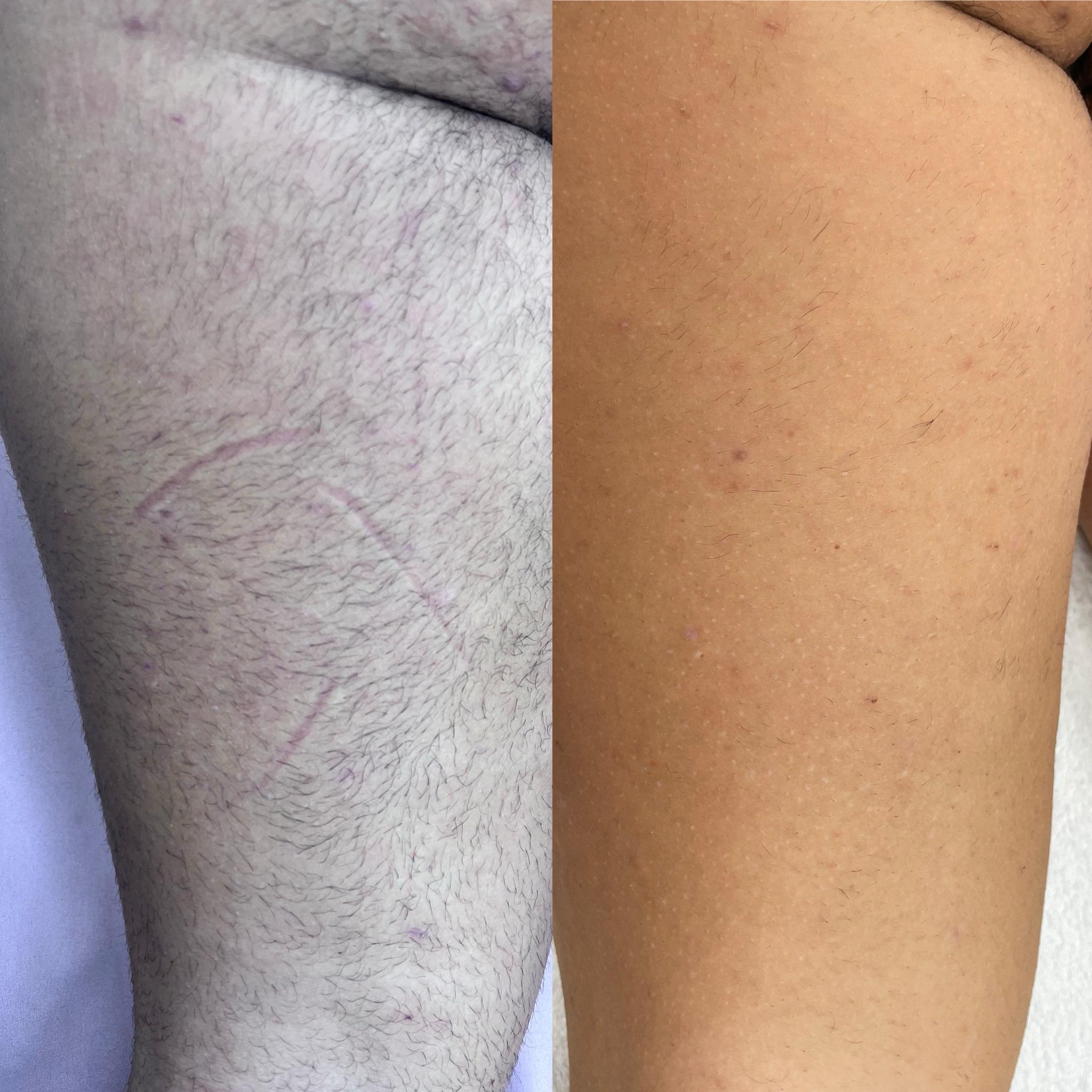 prima e dopo laser centro estetico catanzaro (7)