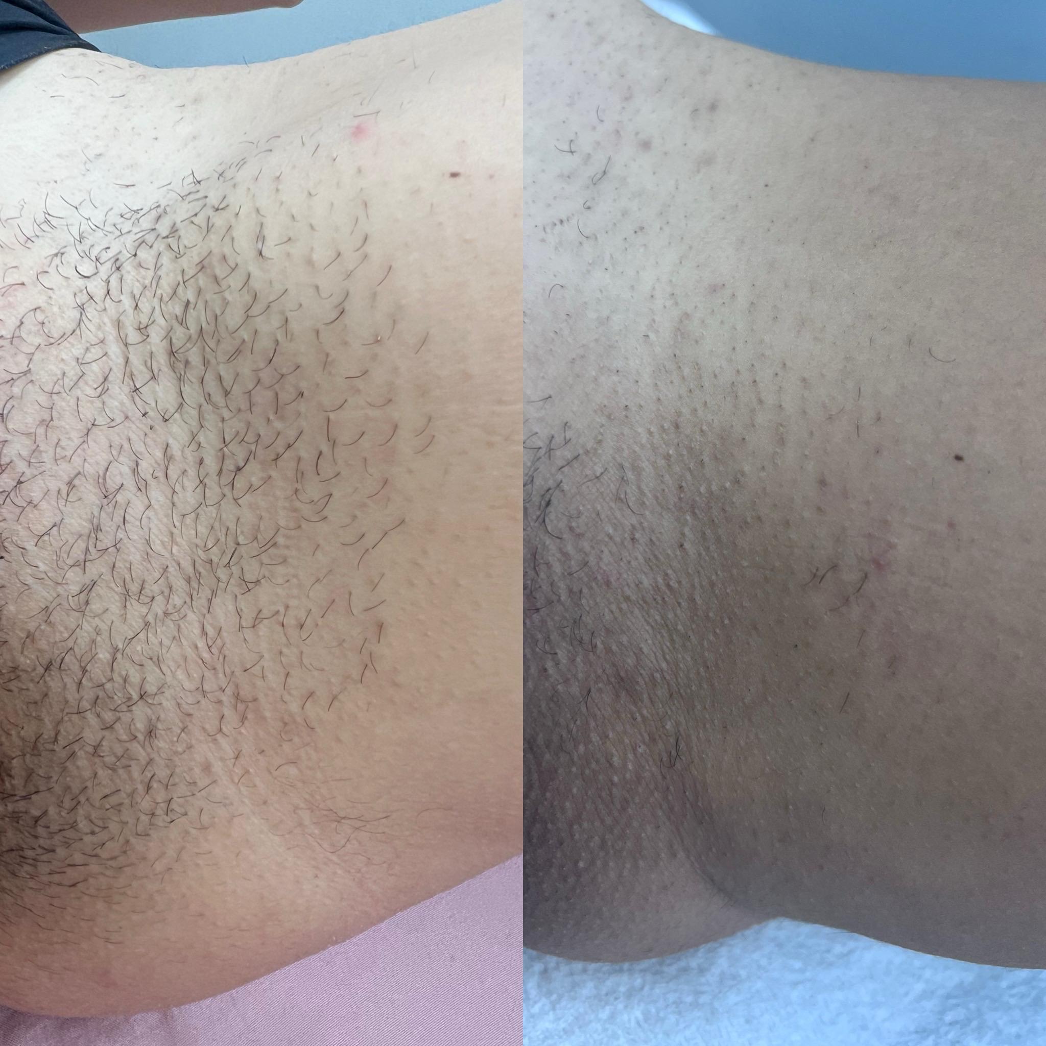 prima e dopo laser centro estetico catanzaro (9)